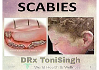 Scabies.pdf